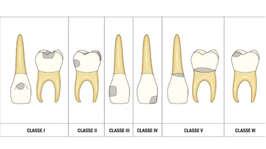 ODONTOIATRIA CONSERVATIVA CLASSI CAVITARIE